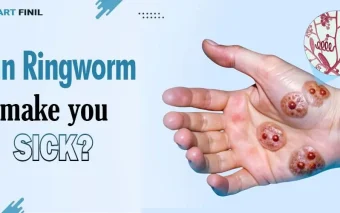 Can ringworm make you sick? 6 Can ringworms make you sick?