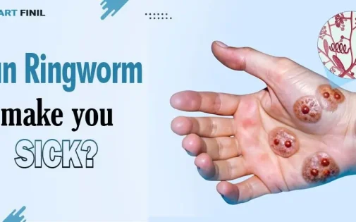 Can ringworms make you sick?