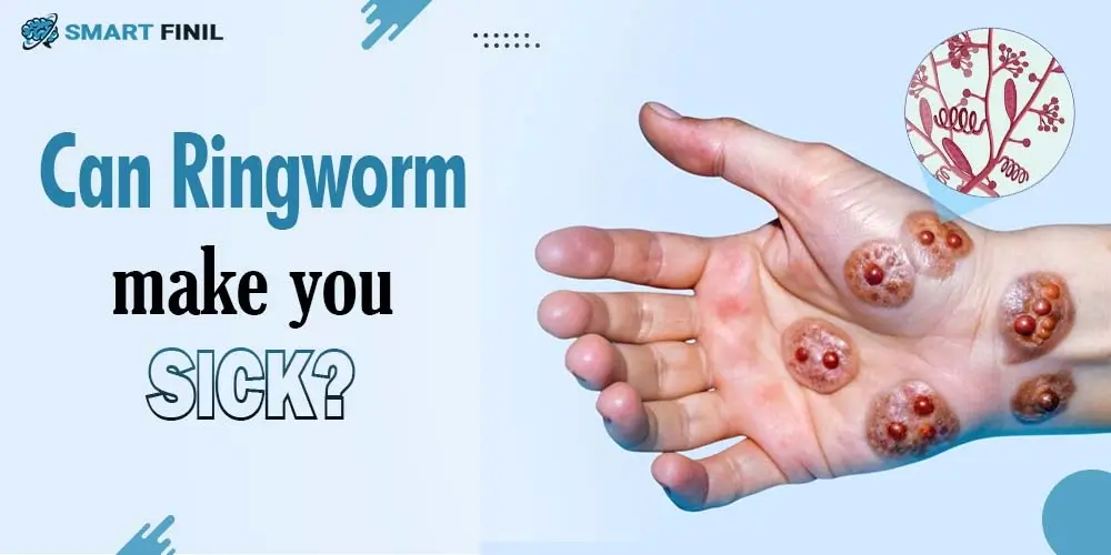Can ringworms make you sick?