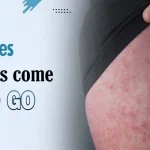 Does cellulitis come and go