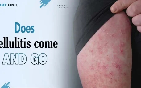 Does cellulitis come and go 2 Does cellulitis come and go