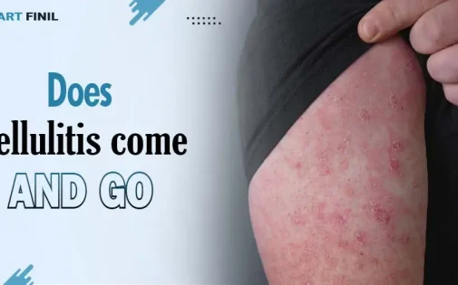 Does cellulitis come and go