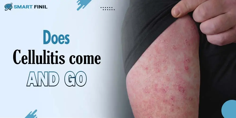 Does cellulitis come and go